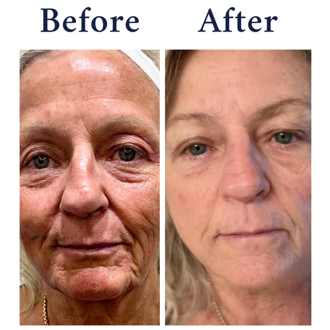 NeoGen Plasma Lift wrinkle reduction