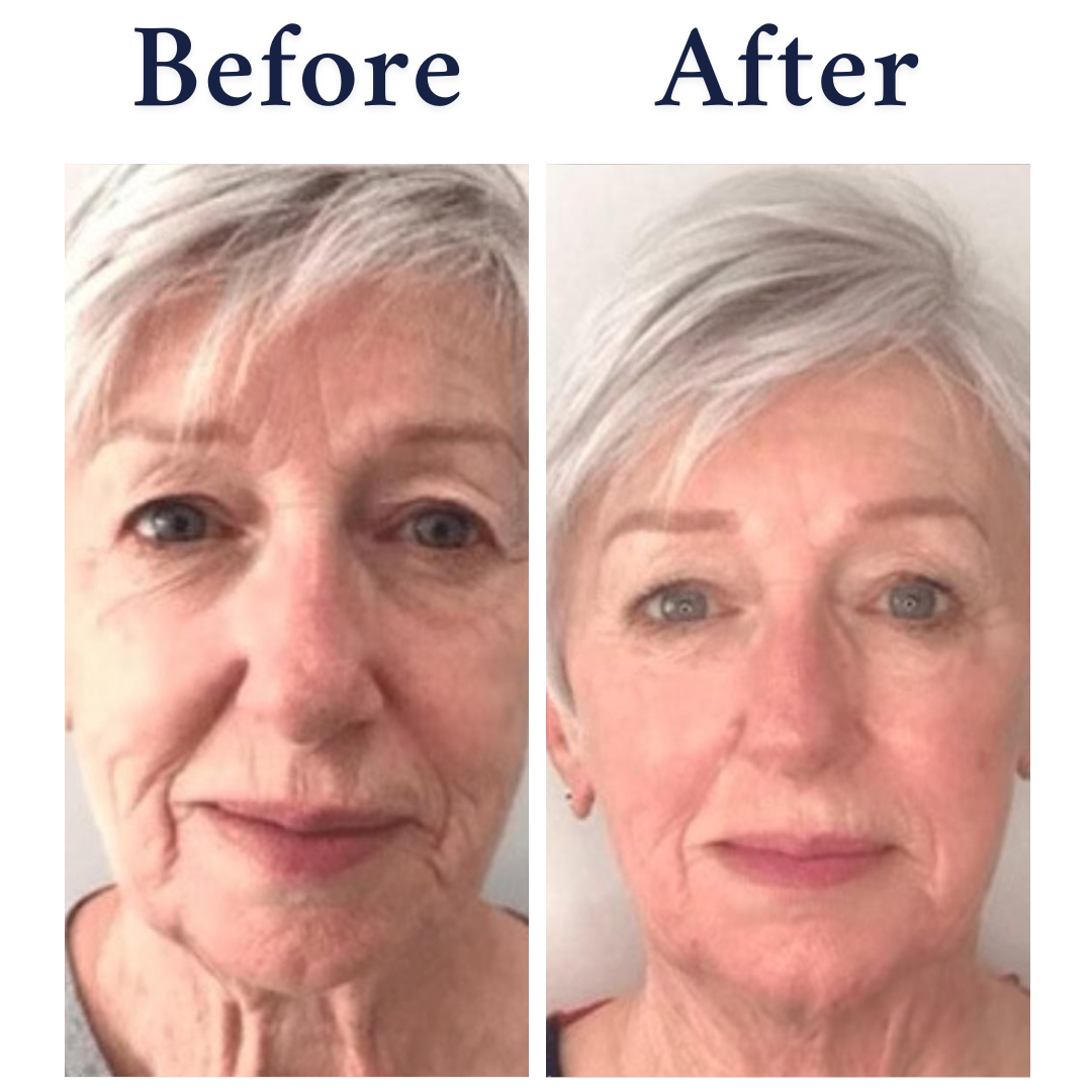 NeoGen Plasma Lift for lines and wrinkles results