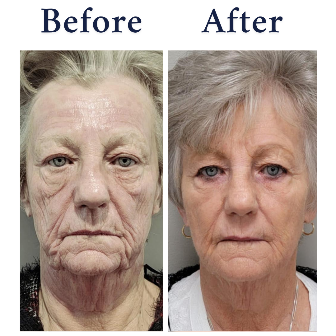NeoGen Plasma Lift before and after wrinkles