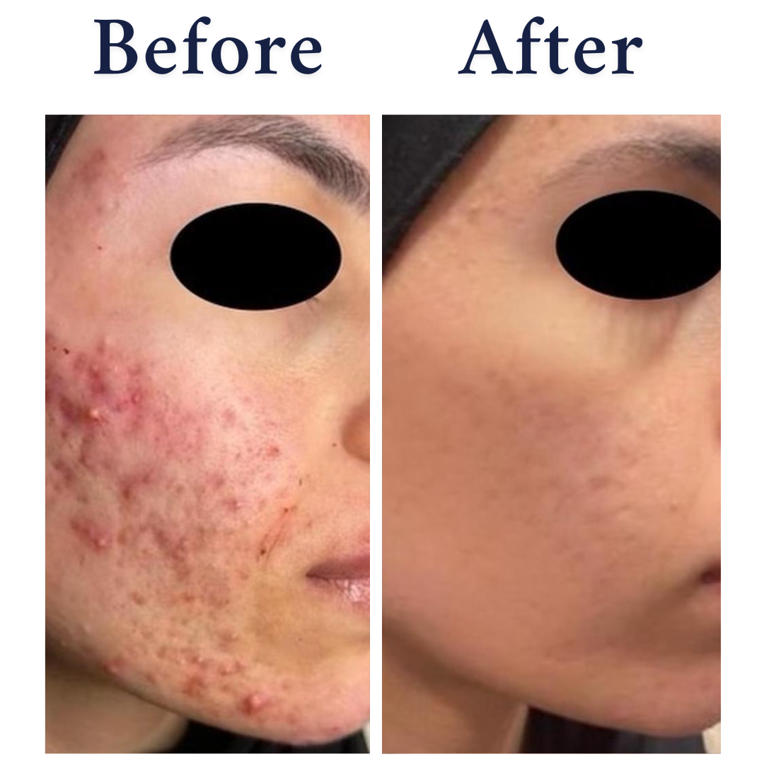 Active Acne and Acne Scars