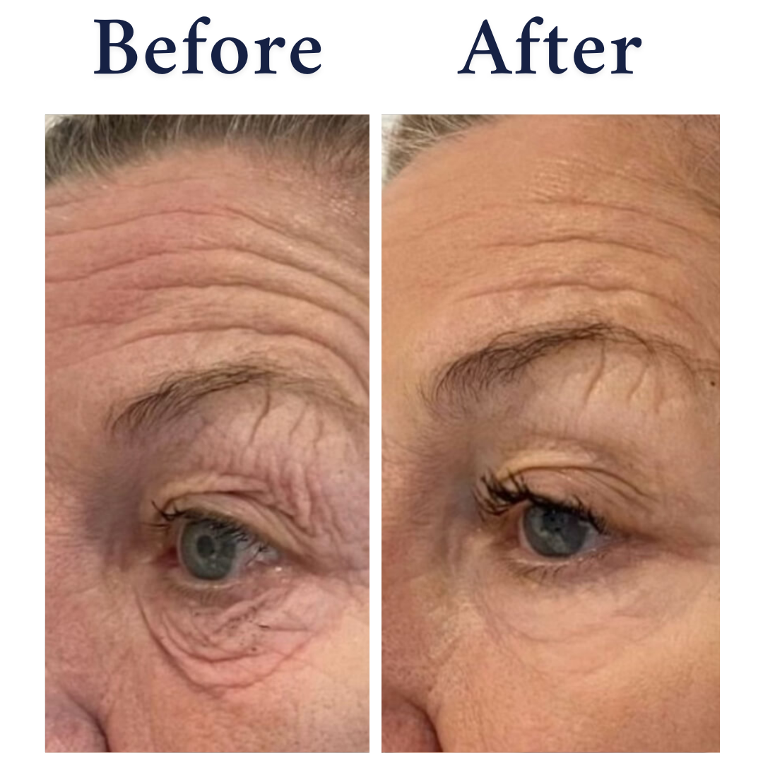 NeoGen Eyelift
