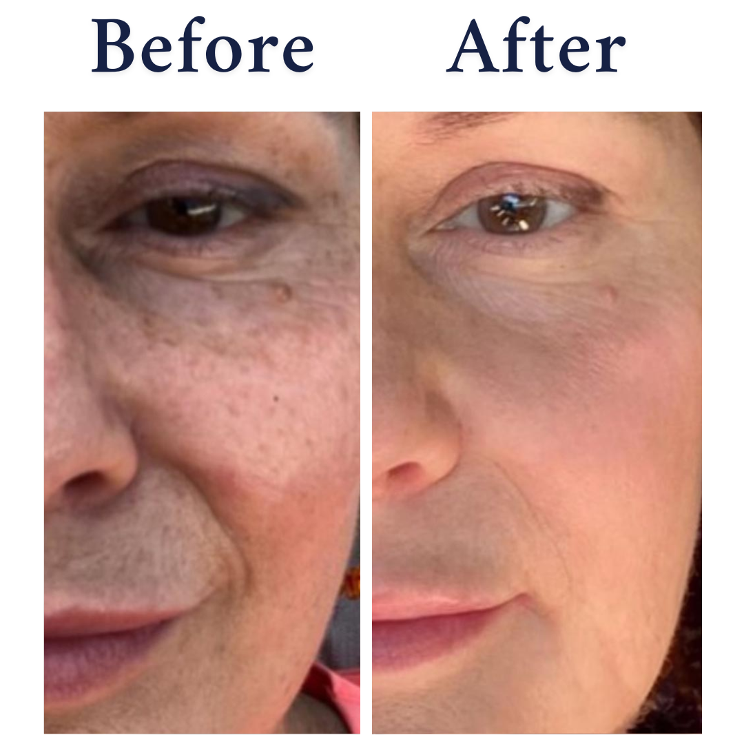 Pigmentation & Sun Damage