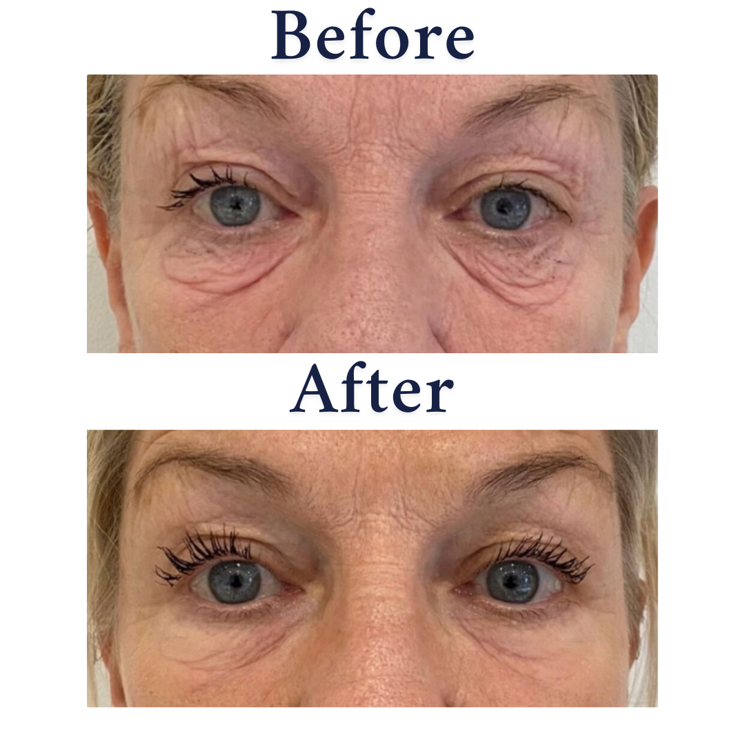 NeoGen Eyelift
