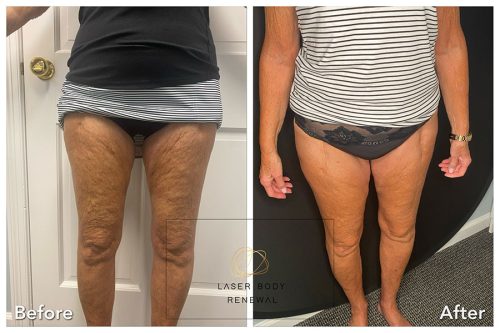 One NeoGen Session at 3.5 Jules - Thighs and Knees
