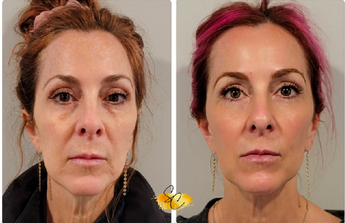 Melissa-low-energy-30-days-after