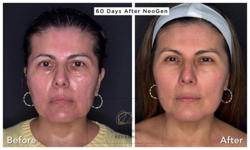 60 Days After NeoGen