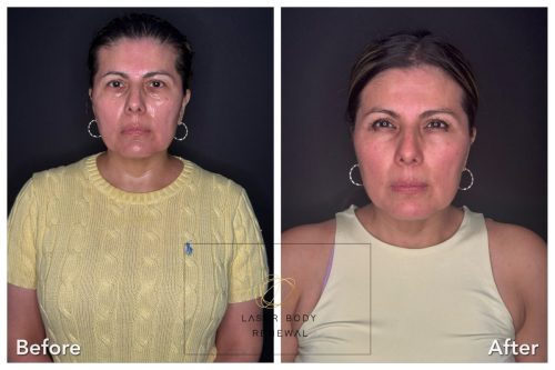 6-weeks-after-Staright-Elsa-Lopez-min