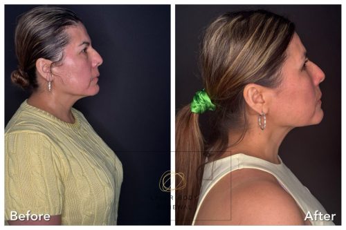 6-weeks-after-neoGen-Elsa-Lopez-Right-min