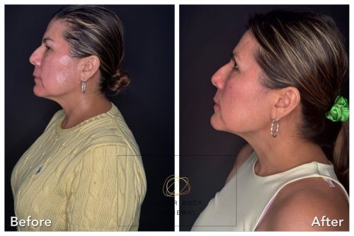 6-weeks-after-neoGen-Left-Side-Elsa-Lopez-min