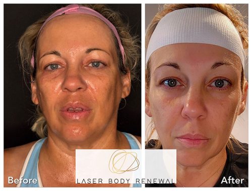 54 year old Female 30 days post NeoGen Lyft.  Face and neck and eyes done at 3.5 Jules.